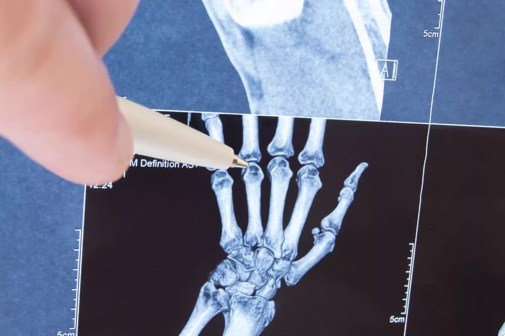 ביטוח לאומי: כמה שווה שבר באצבע?